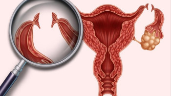 Chụp tử cung vòi trứng giúp chuẩn đoán hiếm muộn ở nữ