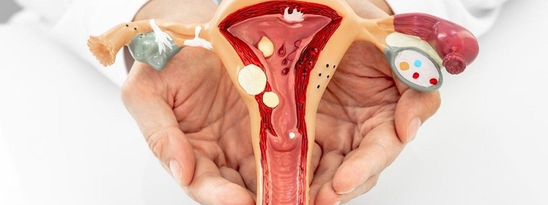 Polyp nội mạc tử cung: Nguyên nhân và phương pháp điều trị