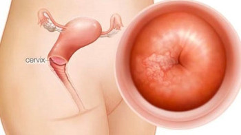 Viêm lộ tuyến tử cung ảnh hưởng đến thai phụ và thai nhi ra sao?