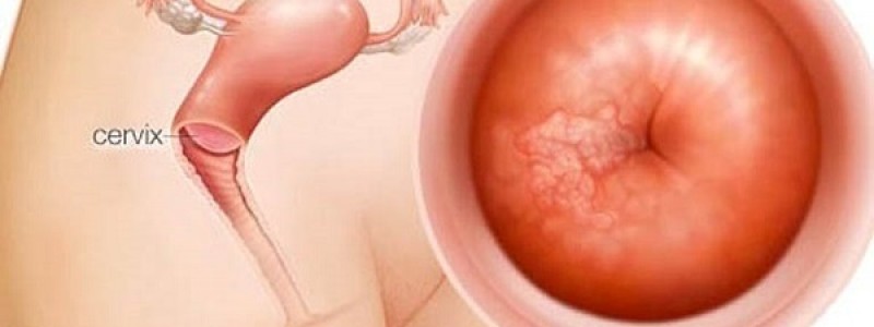 Viêm lộ tuyến tử cung ảnh hưởng đến thai phụ và thai nhi ra sao?