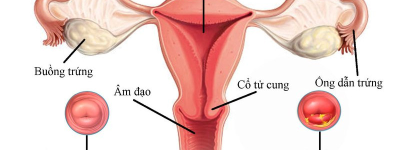 Viêm lộ tuyến cổ tử cung là gì?