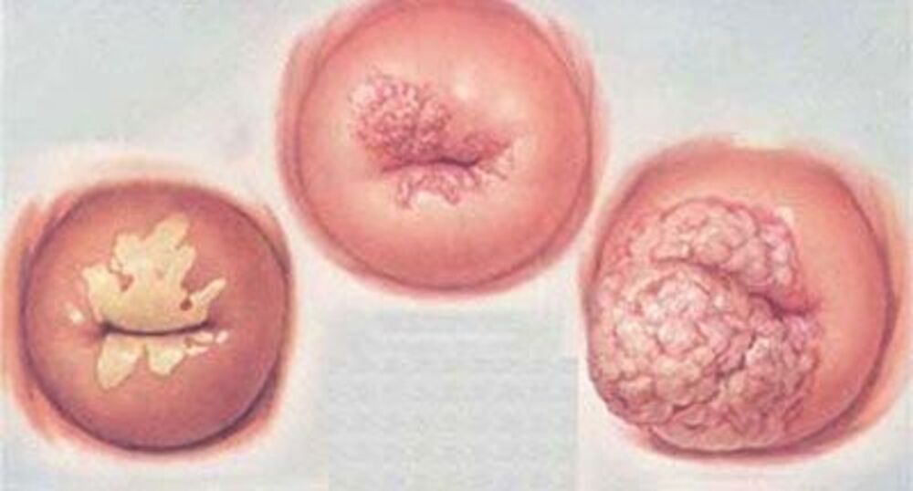 Viêm lộ tuyến tử cung ảnh hưởng đến thai phụ và thai nhi ra sao