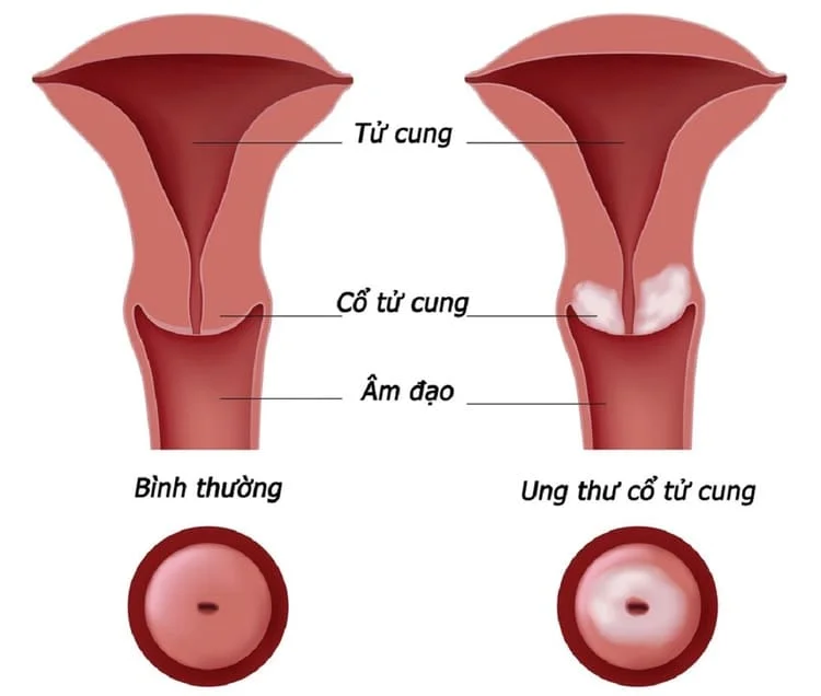 Khi nào cần, nên thực hiện soi cổ tử cung Khi nào cần, nên thực hiện soi cổ tử cung