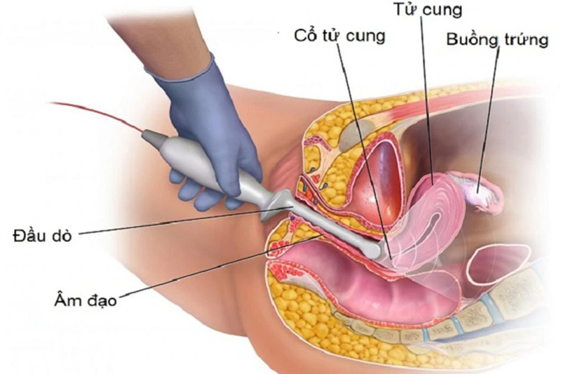Siêu âm đầu dò sieu-am-dau-do