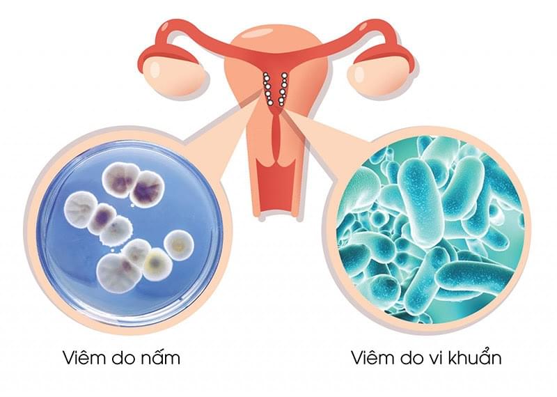 viêm nhiễm phụ khoa còn có thể là do phá thai không an toàn viem-nhiem-phu-khoa-1