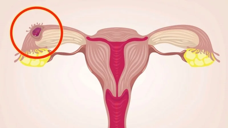 Chửa ngoài dạ con có nguy hiểm không? Dấu hiệu và điều trị thế nào? 2 Chửa ngoài dạ con có nguy hiểm không