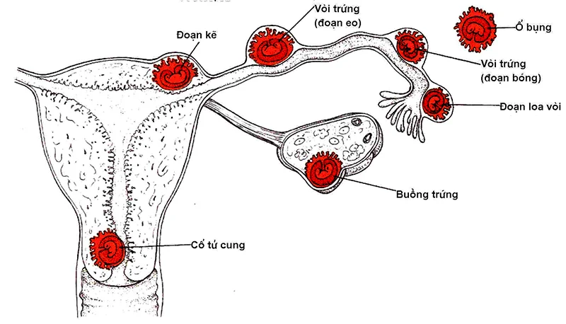 Chửa ngoài dạ con có nguy hiểm không? Dấu hiệu và điều trị thế nào? 1 Chửa ngoài dạ con có nguy hiểm không