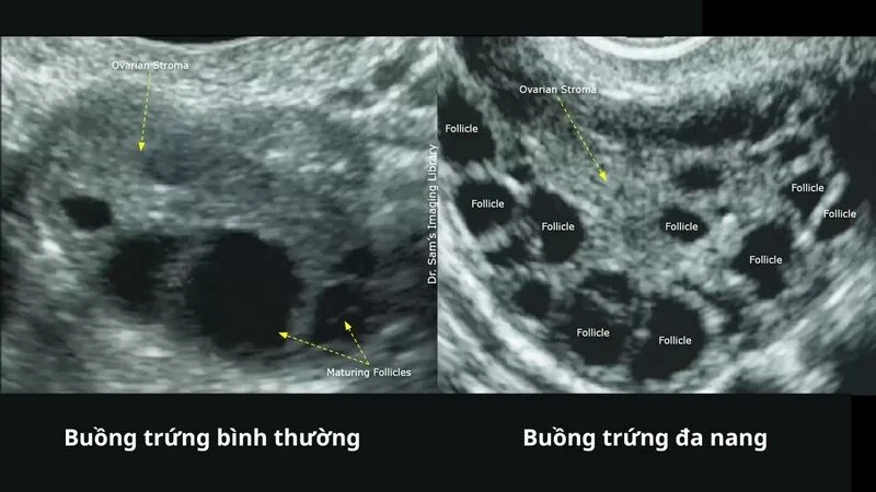 Siêu âm buồng trứng có cần phải nhịn ăn không? 1 Siêu âm buồng trứng có cần phải nhịn ăn không?