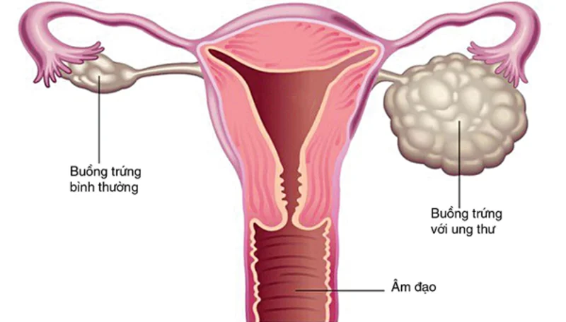 Siêu âm buồng trứng có đau không? Cần lưu ý gì khi siêu âm? 3 Siêu âm buồng trứng có đau không? Cần lưu ý gì trước và sau khi siêu âm?