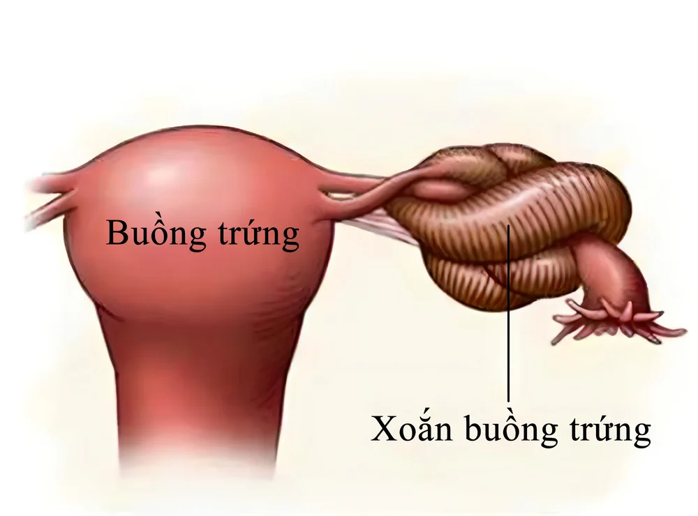 Siêu âm buồng trứng là gì? Cách thực hiện & ưu, nhược điểm 3 Siêu âm buồng trứng là gì_ Giải thích chi tiết cho người mới