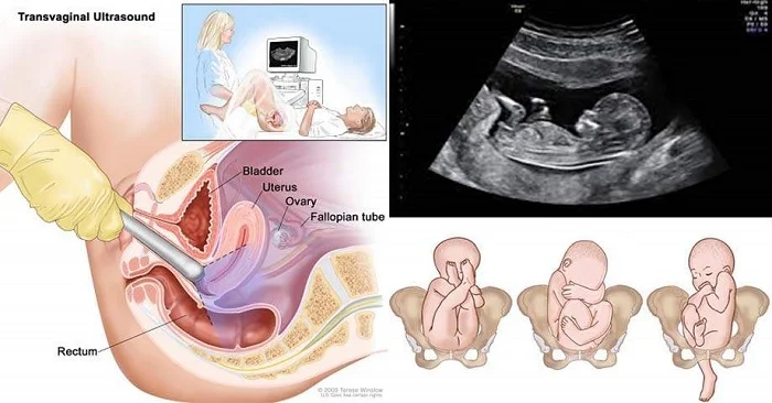 Top 3 bệnh lý nguy hiểm có thể phát hiện sớm bằng Siêu âm đầu dò 1 Top 3 bệnh lý nguy hiểm có thể phát hiện sớm bằng Siêu âm đầu dò