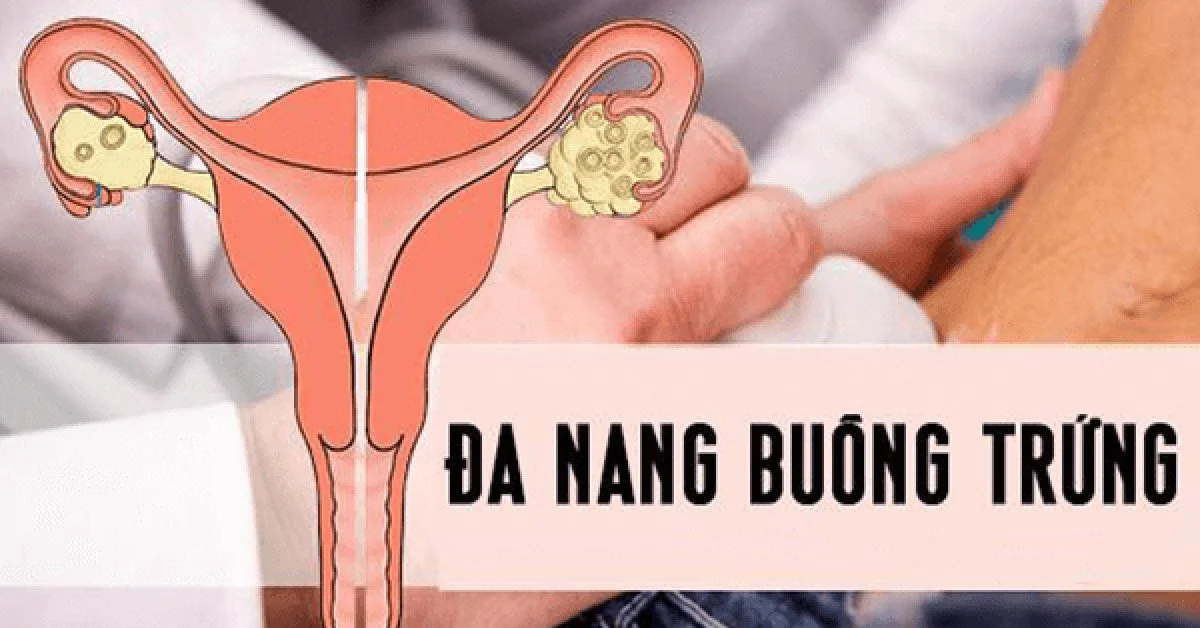 8 dấu hiệu buồng trứng đa nang bạn không nên bỏ qua 3 8 dấu hiệu buồng trứng đa nang bạn không nên bỏ qua