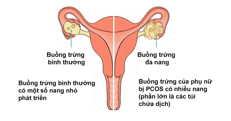 Mách bạn 3 cách điều trị buồng trứng đa nang hiệu quả 1 Mách bạn 3 cách điều trị buồng trứng đa nang hiệu quả