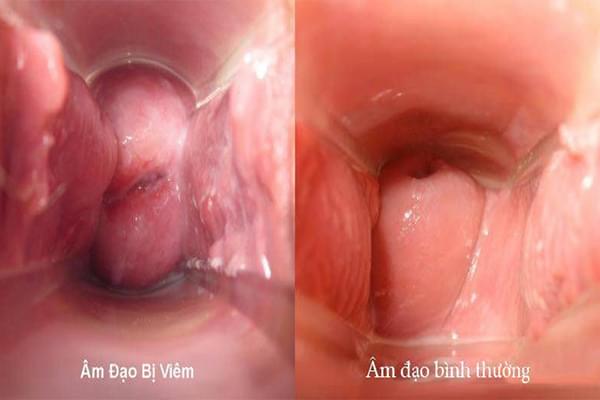 Hội Chứng Viêm Phụ Khoa Ở Phụ Nữ Hội Chứng Viêm Phụ Khoa Ở Phụ Nữ