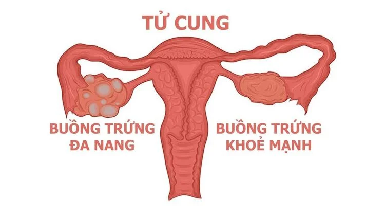Từ A - Z các thông tin về hội chứng buồng trứng đa nang 2 hội chứng buồng trứng đa nang