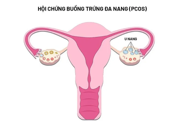 Từ A - Z các thông tin về hội chứng buồng trứng đa nang 3 hội chứng buồng trứng đa nang