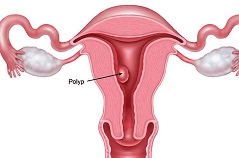 Polyp nội mạc tử cung: Nguyên nhân và phương pháp điều trị 1 polyp-noi-mac-tu-cung-nguyen-nhan-va-phuong-phap-dieu-tri-3