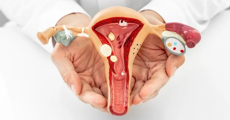 Polyp nội mạc tử cung: Nguyên nhân và phương pháp điều trị polyp-noi-mac-tu-cung-nguyen-nhan-va-phuong-phap-dieu-tri-3