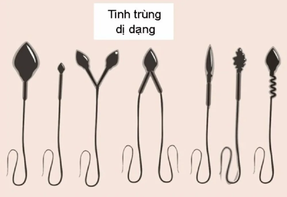 Tinh trùng dị dạng có ảnh hưởng đến thai nhi không? 1 Tinh trùng dị dạng có ảnh hưởng đến thai nhi không