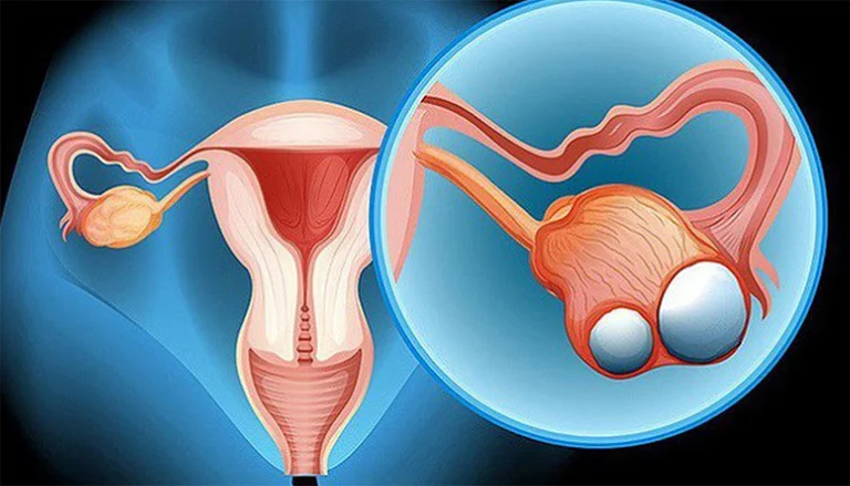 U nang buồng trứng dạng nước có nguy hiểm không? Điều trị thế nào? 2 u-nang-buong-trung-dang-nuoc-co-nguy-hiem-khong-dieu-tri-the-nao