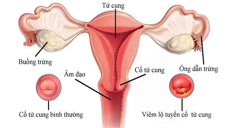Hội Chứng Viêm Phụ Khoa Ở Phụ Nữ Hội Chứng Viêm Phụ Khoa Ở Phụ Nữ