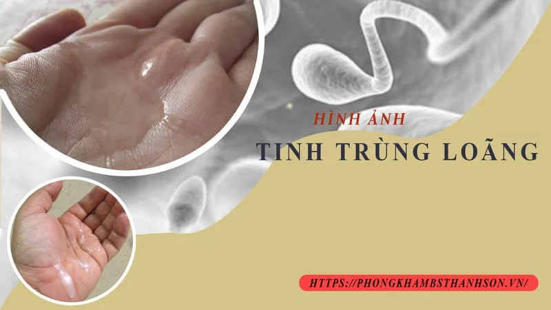 Vô sinh ở Nam giới - Chuẩn đoán và điều trị như thế nào? 5 vo sinh o nam gioi chuan doan va dieu tri 6