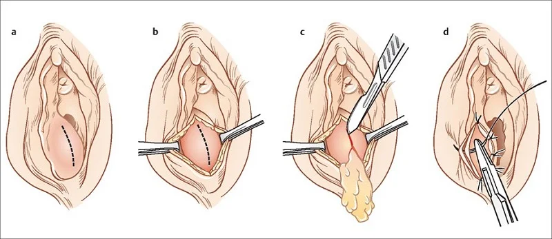 Chích áp xe tuyến Bartholin: Quy trình, chi phí & địa chỉ uy tín 2 Chích áp xe tuyến Bartholin - Thực hiện ở đâu để đảm bảo an toàn, ít đau đớn