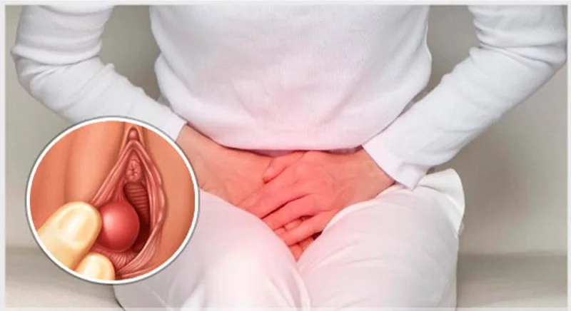 Chích áp xe tuyến Bartholin: Quy trình, chi phí & địa chỉ uy tín 1 Chích áp xe tuyến Bartholin: Quy trình, chi phí & địa chỉ uy tín