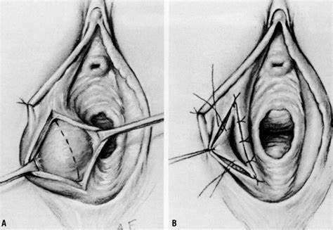 Chích áp xe tuyến Bartholin ở đâu uy tín? Dr Thành Sơn, Long Biên 3 Chích áp xe tuyến Bartholin ở đâu uy tín Dr Thành Sơn, Long Biên