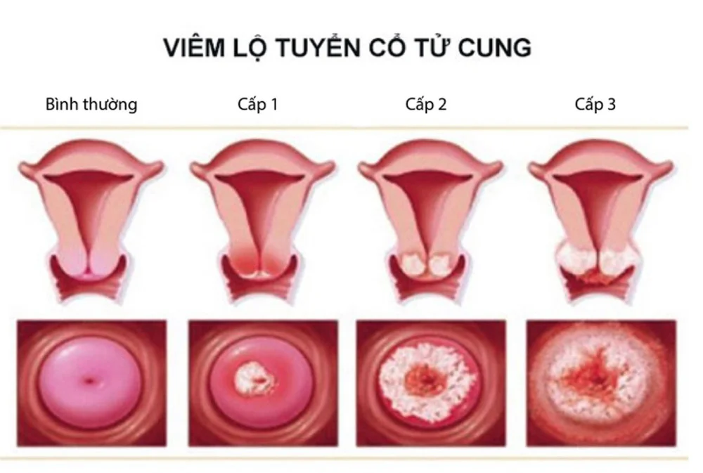 Điều trị viêm lộ tuyến cổ tử cung ở đâu uy tín tại Hà Nội? 1 Điều trị viêm lộ tuyến cổ tử cung ở đâu uy tín tại Hà Nội