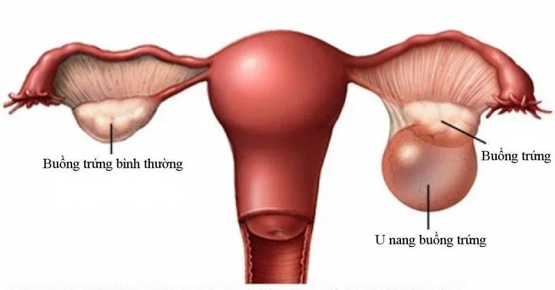 U nang buồng trứng là gì? Nguyên nhân, triệu chứng và cách điều trị hiệu quả 1 U nang buồng trứng là gì? Nguyên nhân, triệu chứng và cách điều trị hiệu quả