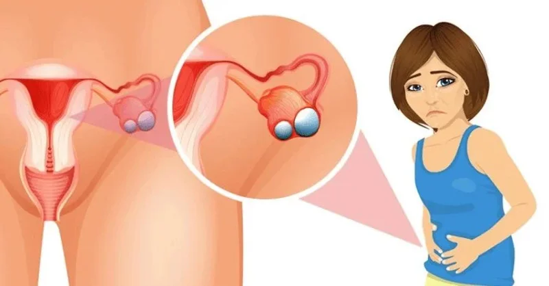 U nang buồng trứng là gì? Nguyên nhân, triệu chứng và cách điều trị hiệu quả 3 U nang buồng trứng là gì? Nguyên nhân, triệu chứng và cách điều trị hiệu quả