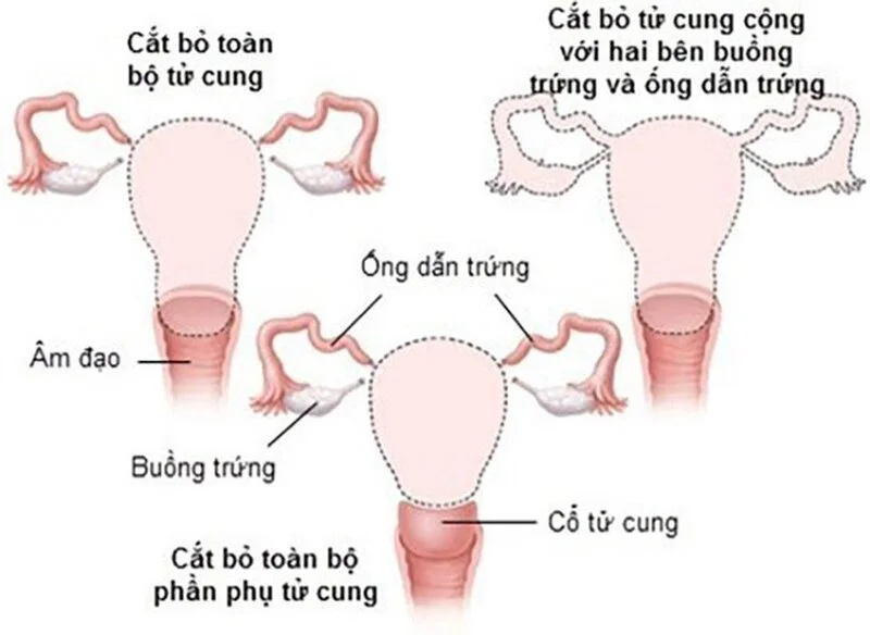 U nang buồng trứng là gì? Nguyên nhân, triệu chứng và cách điều trị hiệu quả 4 U nang buồng trứng là gì? Nguyên nhân, triệu chứng và cách điều trị hiệu quả