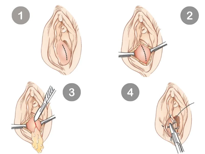 Chích áp xe tuyến Bartholin là gì? Quy trình thực hiện như thế nào? 4 Chích áp xe tuyến Bartholin là gì? Quy trình thực hiện như thế nào?
