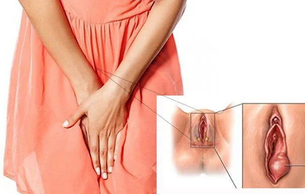 Chích áp xe tuyến Bartholin là gì? Quy trình thực hiện như thế nào? 5 Chích áp xe tuyến Bartholin là gì? Quy trình thực hiện như thế nào?