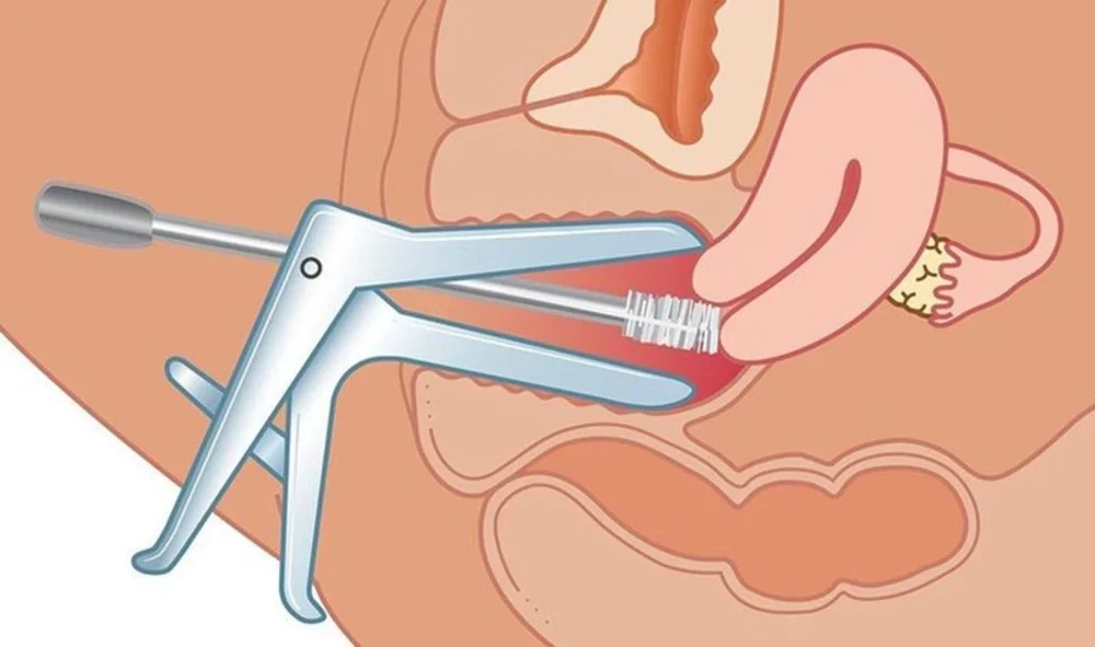 Soi cổ tử cung là gì? Quy trình, lợi ích và những điều cần biết 3 Soi cổ tử cung là gì? Quy trình, lợi ích và những điều cần biết