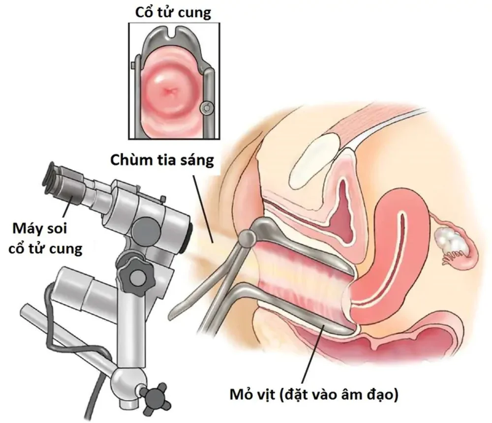 Soi cổ tử cung là gì? Quy trình, lợi ích và những điều cần biết 1 Soi cổ tử cung là gì? Quy trình, lợi ích và những điều cần biết