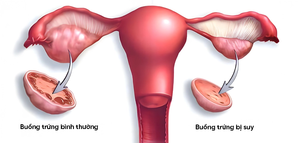Suy buồng trứng là gì? Nguyên nhân, dấu hiệu và cách điều trị 1 Suy buồng trứng là gì? Nguyên nhân, dấu hiệu và cách điều trị