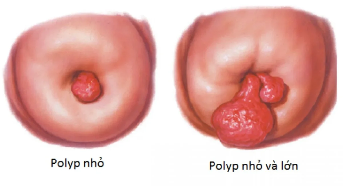 Thủ thuật xoắn polyp cổ tử cung là gì? Ưu nhược điểm? 1 Thủ thuật xoắn polyp cổ tử cung là gì (1)