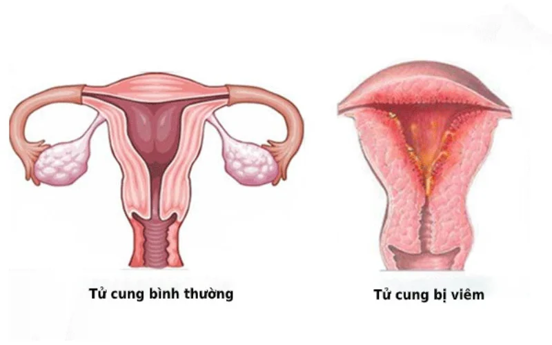 Thủ thuật xoắn polyp cổ tử cung là gì? Ưu nhược điểm? 5 Thủ thuật xoắn polyp cổ tử cung là gì? Ưu nhược điểm?