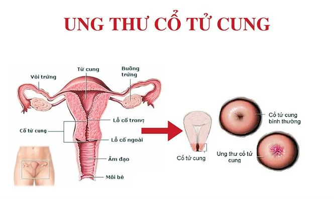 7+ bệnh phụ khoa thường gặp và nguy hiểm nhất hiện nay 4 7+ bệnh phụ khoa thường gặp và nguy hiểm nhất hiện nay