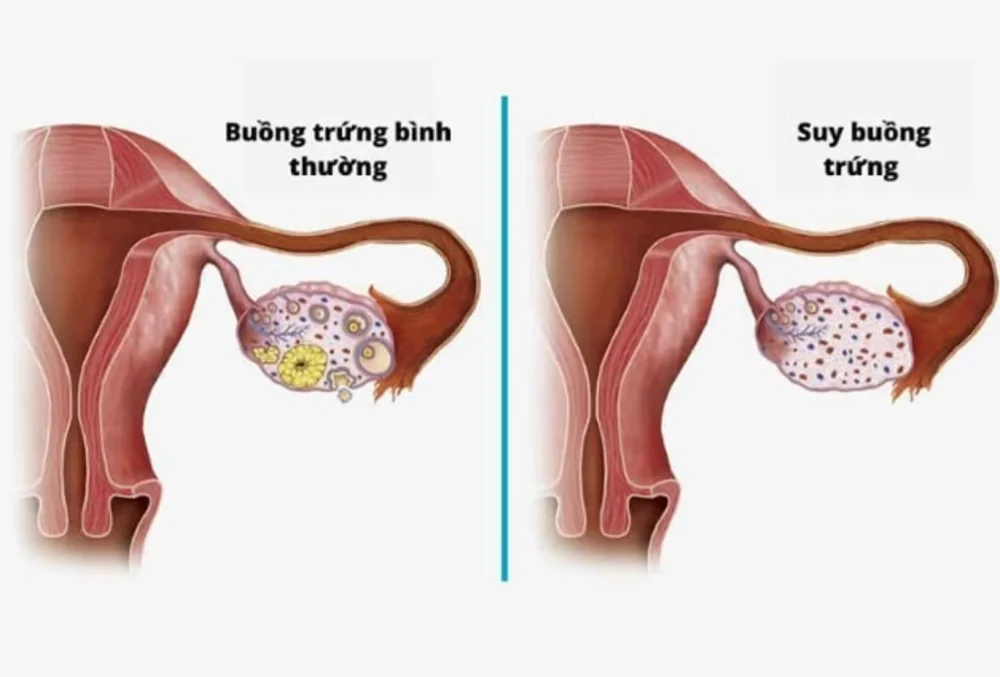 Rối loạn nội tiết – nguyên nhân thường gặp khiến trứng phát triển kém, niêm mạc mỏng 3 Rối loạn nội tiết – nguyên nhân thường gặp khiến trứng phát triển kém, niêm mạc mỏng