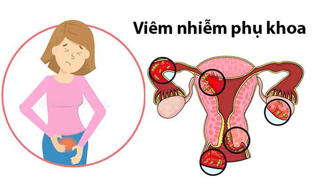 Các bệnh lý phụ khoa thường gặp gây ra vô sinh hiếm muộn Các bệnh lý phụ khoa thường gặp gây ra vô sinh hiếm muộn
