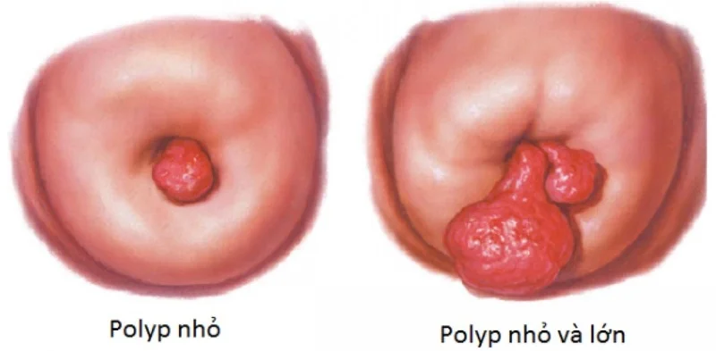 Dr Thành Sơn - Địa chỉ xoắn polyp cổ tử cung UY TÍN ở Hà Nội 1 Trong các phương pháp điều trị, xoắn polyp cổ tử cung được đánh giá là thủ thuật đơn giản nhưng mang lại hiệu quả cao, giúp loại bỏ polyp triệt để và nhanh chóng. Tại Hà Nội, Dr Thành Sơn được đông đảo chị em lựa chọn nhờ sự kết hợp giữa chuyên môn vững vàng – quy trình an toàn – chi phí minh bạch, mang lại sự an tâm trong từng ca thăm khám.
1. Polyp cổ tử cung – Bệnh lý không nên xem nhẹ
1.1 Nguyên nhân và biểu hiện thường gặp
Polyp hình thành do sự phát triển bất thường của tế bào niêm mạc cổ tử cung. Các yếu tố như rối loạn nội tiết, viêm nhiễm mạn tính, hoặc tác động cơ học kéo dài có thể là nguyên nhân thúc đẩy. Chị em thường phát hiện polyp khi gặp:
Ra máu bất thường ngoài kỳ kinh hoặc sau quan hệ.
Khí hư nhiều, có mùi khó chịu.
Khó thụ thai dù quan hệ đều đặn.
1.2 Nguy cơ nếu không điều trị kịp thời
Đa phần polyp lành tính, nhưng việc để lâu có thể dẫn đến viêm nhiễm kéo dài, gây bít tắc cổ tử cung và cản trở tinh trùng gặp trứng. Đặc biệt, một số trường hợp polyp có thể biến đổi bất thường, cần được can thiệp để loại trừ nguy cơ ác tính. Chính vì vậy, việc thăm khám sớm và xử lý bằng thủ thuật xoắn polyp cổ tử cung là vô cùng cần thiết.
2. Vì sao nên chọn Dr Thành Sơn để xoắn polyp cổ tử cung?
2.1 Bác sĩ nhiều năm kinh nghiệm trong sản phụ khoa
Dr Thành Sơn đã thăm khám và điều trị thành công nhiều trường hợp polyp cổ tử cung phức tạp. Bác sĩ không chỉ giỏi chuyên môn mà còn am hiểu tâm lý bệnh nhân, tạo sự thoải mái trong quá trình trao đổi – điều mà nhiều chị em e ngại khi đi khám phụ khoa.
2.2 Quy trình thủ thuật an toàn – chính xác
Tại phòng khám của Dr Thành Sơn, thủ thuật xoắn polyp cổ tử cung được tiến hành theo chuẩn y khoa:
Bác sĩ kiểm tra kỹ lưỡng để xác định vị trí, kích thước và số lượng polyp.
Dụng cụ chuyên dụng được vô trùng tuyệt đối, thao tác nhẹ nhàng nhằm giảm đau và hạn chế tổn thương.
Sau thủ thuật, vùng xoắn được cầm máu và vệ sinh sạch sẽ, đồng thời kiểm tra lại để chắc chắn không còn dị vật sót lại.
2.3 Lợi ích khi điều trị tại Dr Thành Sơn
Nhanh chóng: Toàn bộ thủ thuật diễn ra trong thời gian ngắn, ít gây khó chịu.
Hiệu quả: Polyp được loại bỏ và giảm nguy cơ tái phát.
Chi phí minh bạch: Mức giá rõ ràng, phù hợp, không phát sinh bất ngờ.
Không gian kín đáo: Giúp chị em yên tâm khi thăm khám những vấn đề nhạy cảm.
3. Chăm sóc sau khi xoắn polyp cổ tử cung
3.1 Hồi phục nhanh nếu tuân thủ hướng dẫn
Sau thủ thuật, chị em thường hồi phục nhanh chóng, có thể sinh hoạt bình thường chỉ sau vài ngày. Tuy nhiên, cần tuân thủ các lưu ý:
Giữ vệ sinh vùng kín sạch sẽ, thay băng vệ sinh thường xuyên nếu có chảy dịch.
Kiêng quan hệ tình dục trong thời gian bác sĩ khuyến cáo để niêm mạc lành hẳn.
Tái khám đúng hẹn để kiểm tra vết thương và loại trừ khả năng tái phát.
3.2 Phòng ngừa polyp quay lại
Một số yếu tố như viêm nhiễm kéo dài, nội tiết tố bất thường có thể khiến polyp tái phát. Vì vậy, chị em cần chú ý đến chế độ dinh dưỡng, nghỉ ngơi, tránh căng thẳng kéo dài và nên khám phụ khoa định kỳ 6–12 tháng/lần.
Nếu bạn đang tìm một địa chỉ xoắn polyp cổ tử cung uy tín ở Hà Nội, Dr Thành Sơn chính là lựa chọn đáng tin cậy. Bạn chỉ cần để lại thông tin tại FORM MẪU hoặc liên hệ Hotline. Đội ngũ bác sĩ và tổ chuyên môn của chúng tôi sẽ hỗ trợ bạn nhanh nhất.