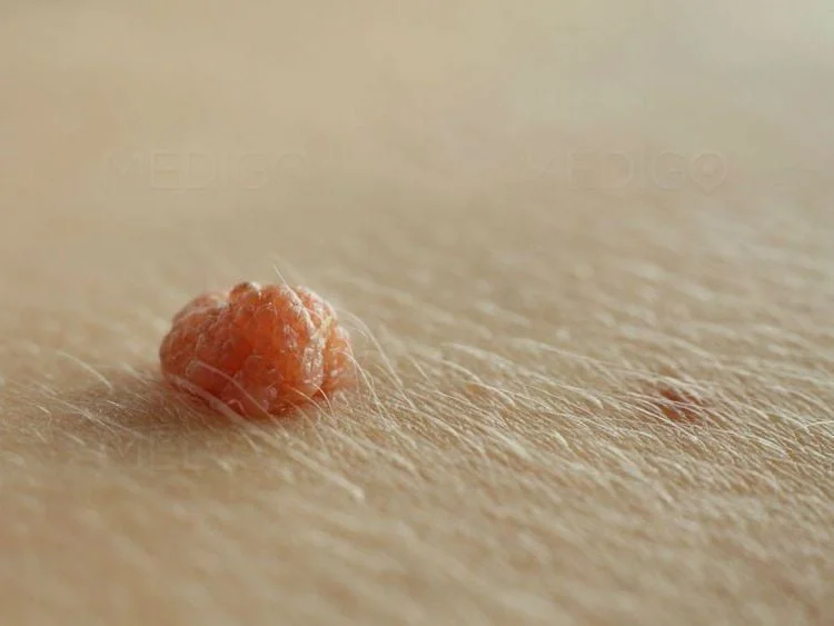HPV là gì? Nguy cơ ở nam giới và mức độ nguy hiểm của type 16, 18 2 HPV là gì? Nguy cơ ở nam giới và mức độ nguy hiểm của type 16, 18