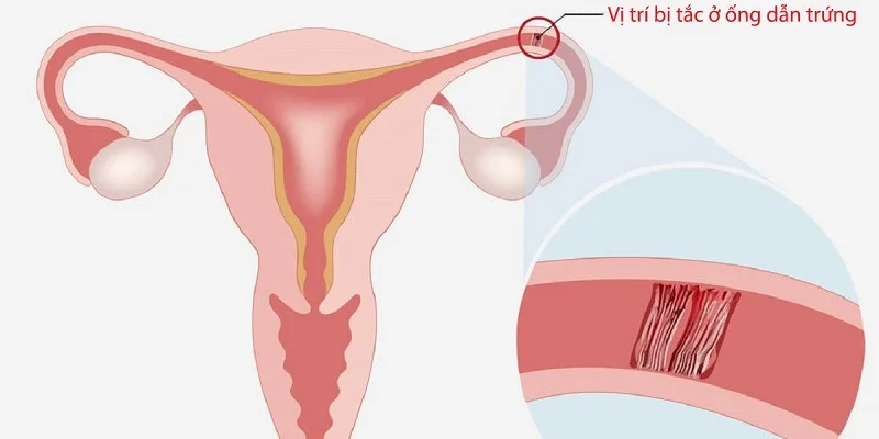 Tư vấn mang thai tự nhiên cho người tắc vòi trứng tại Phòng khám Dr Thành Sơn 1 Tư vấn mang thai tự nhiên cho người tắc vòi trứng tại Phòng khám Dr Thành Sơn