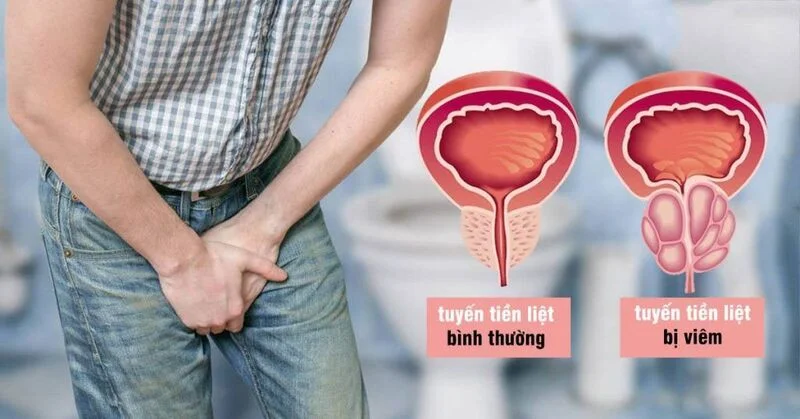 Viêm tuyến tiền liệt – Nam giới quanh Long Biên nên khám ở đâu an toàn? 1 Viêm tuyến tiền liệt – Nam giới quanh Long Biên nên khám ở đâu an toàn?