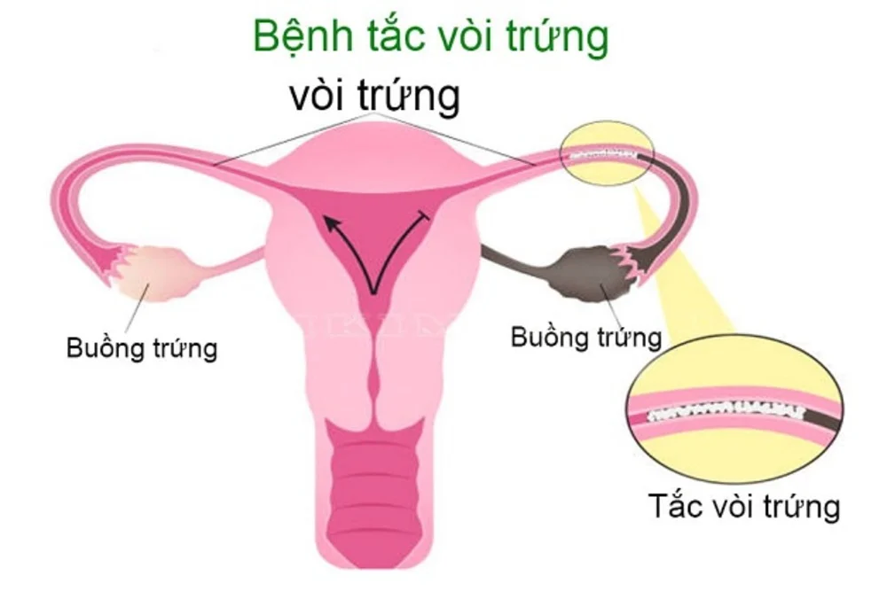 Vô sinh thứ phát là gì? Vì sao từng có con vẫn khó mang thai lại? 2 Vô sinh thứ phát là gì? Vì sao từng có con vẫn khó mang thai lại?